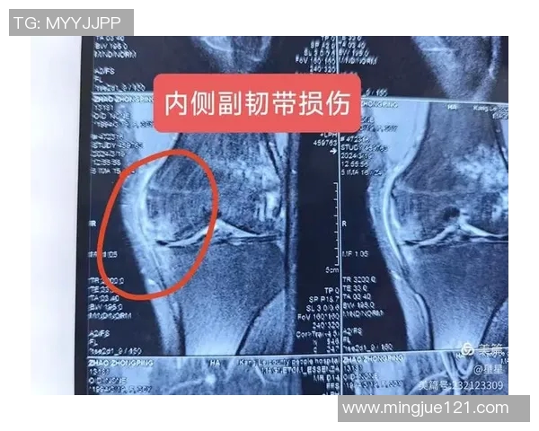 伤情确定！詹姆斯遭遇左膝内侧副韧带二级扭伤